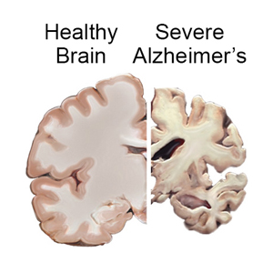 Alzheimer s An Irreversible Progressive Brain Disease