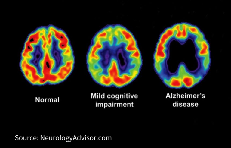 Mild Cognitive Impairment - Alzheimer's San Diego