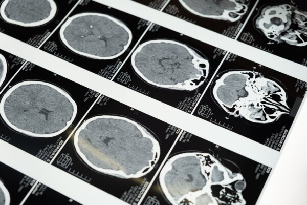 Brain scan for dementia